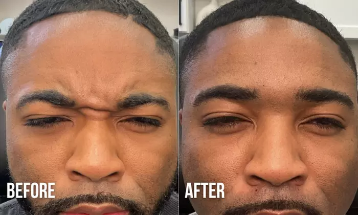 Refreshed Look with 20 or 40 Units of Botox 