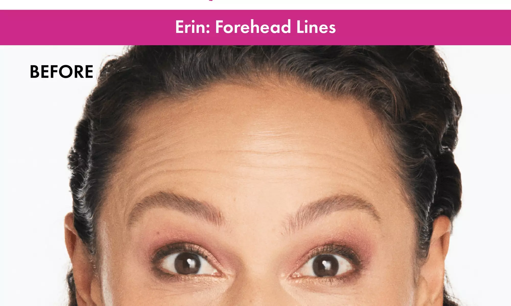 Achieve Radiant Confidence with 20, 40, 60, or 80 Units of Xeomin