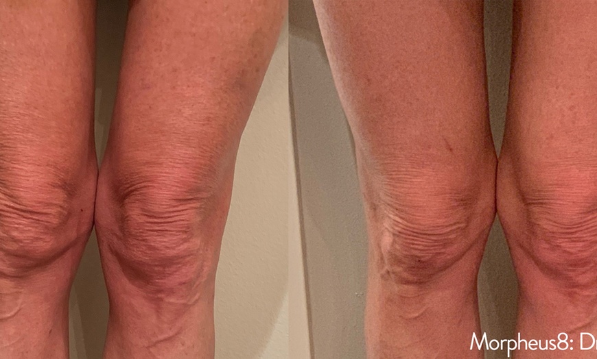 Image 9: Radiant Skin Awaits: Transform with Morpheus8 RF Technology!