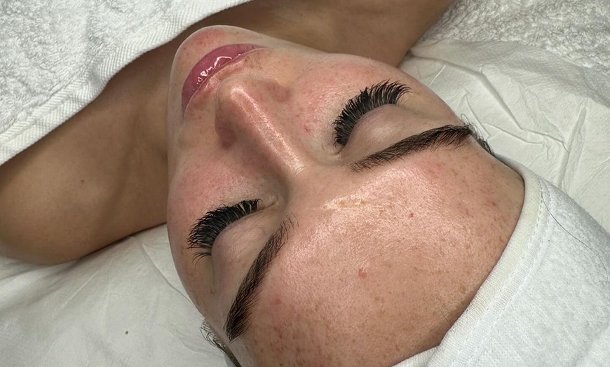 Image 2: Rabatt auf Micro-Needling bei Dzeni’s Beauty&More