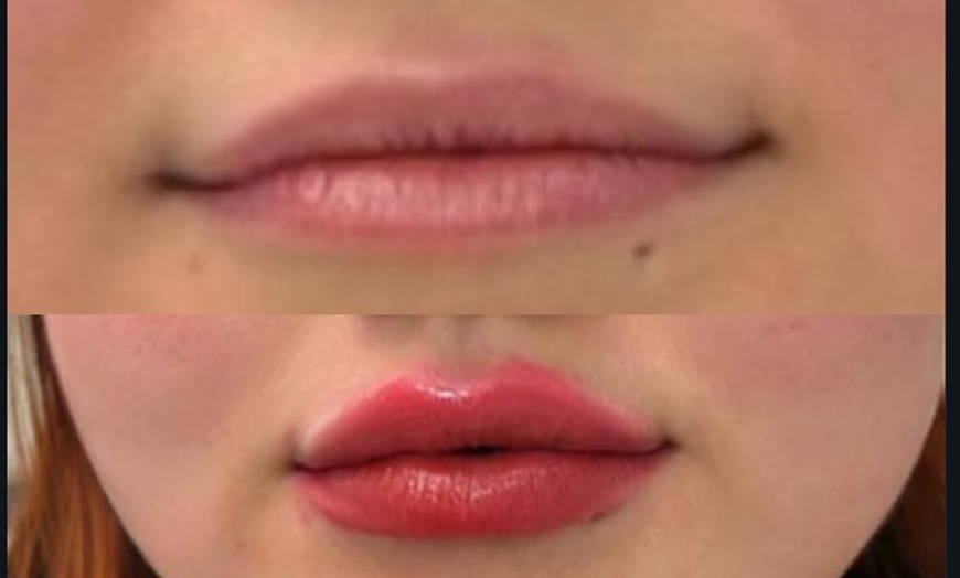 Image 2: Up to 30% Off on Injection - Dermal Filler at No Pain All Gain Spa