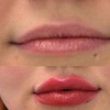 Image 2: Up to 30% Off on Injection - Dermal Filler at No Pain All Gain Spa
