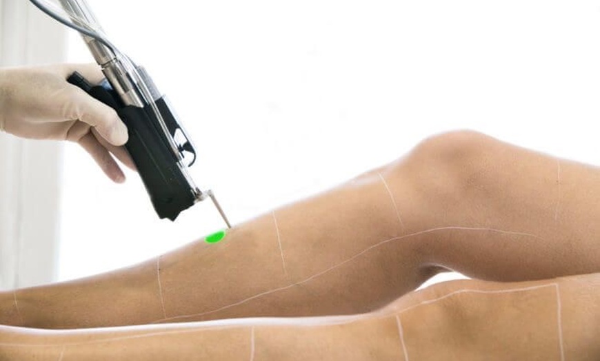 Image 4: Bis zu 60% Rabatt auf den Laser-Haarentfernung bei D Derma Aesthetics