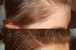 Up to 50% Off on Men and Women's Scalp Micropigmentation Treatments at Derma-Artistry Cosmetic Tattooing - Second Medium
