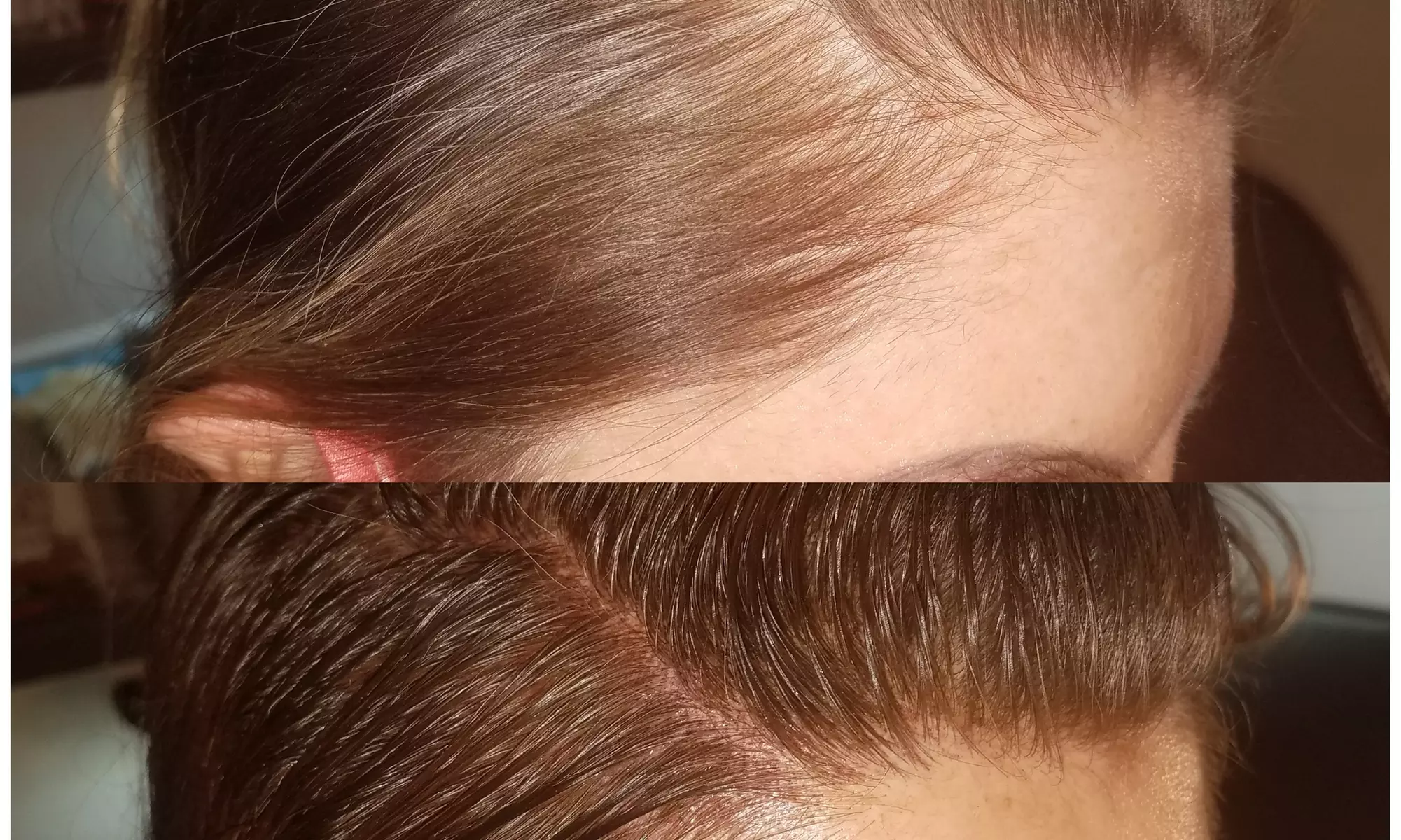 Up to 50% Off on Men and Women's Scalp Micropigmentation
