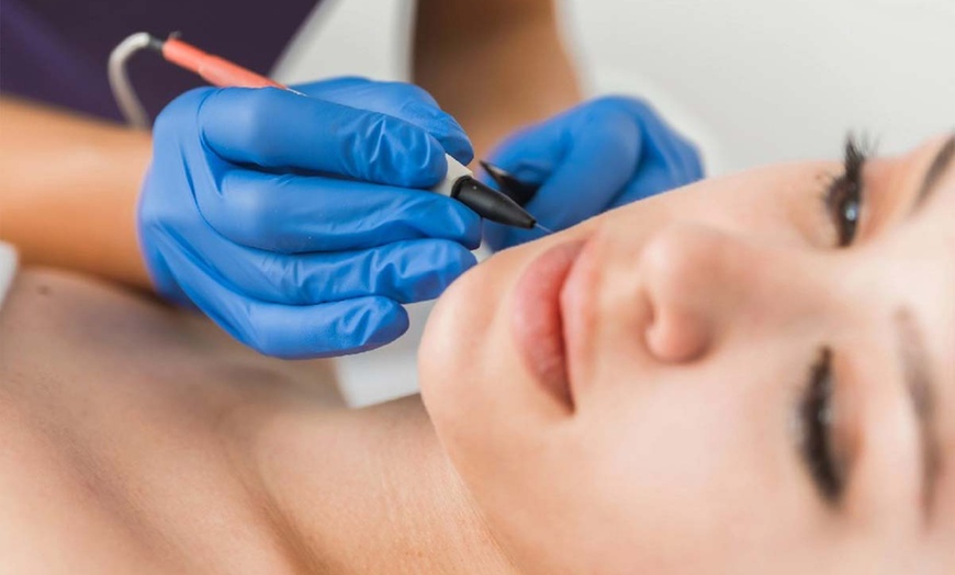 Image 1: Up to 37% Off on Epilfree Hair Removal at Tropical Glow Skin