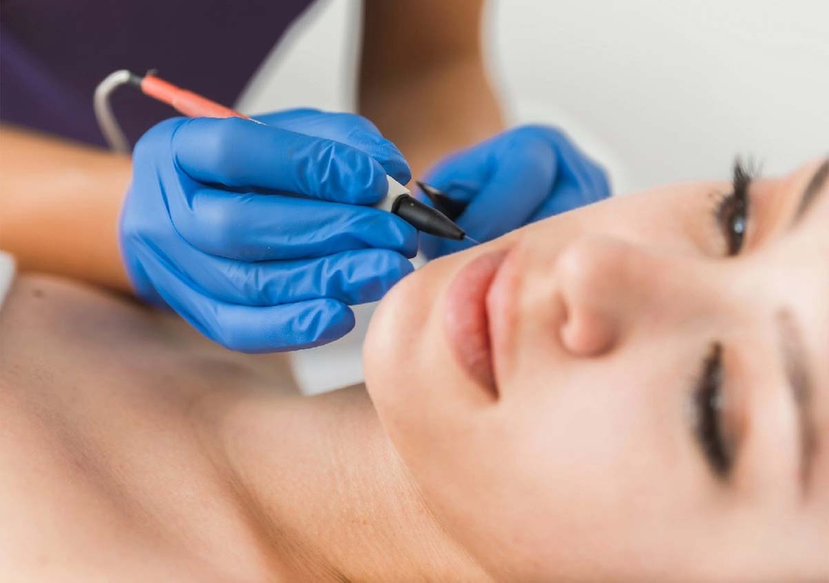 Up to 37% Off on Epilfree Hair Removal at Tropical Glow Skin