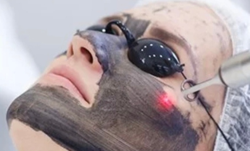 Image 1: Unleash Your Glow: Black Carbon Laser Facial Peel