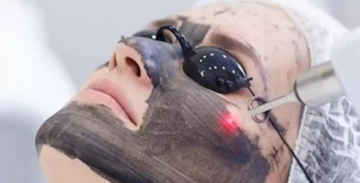 Revitalize Your Skin with Black Carbon Laser Facial Peel at Dermanova Spa And Salon (Up to 56% Off) - Primary Image