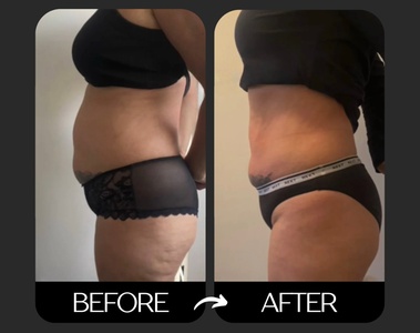 One 30-minute EMS Body Contouring session on the Abdomen - TRUE SCULPT STUDIO