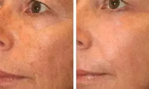 Laser Skin Resurfacing - Fractional - Branded (Fraxel) at Salon Station