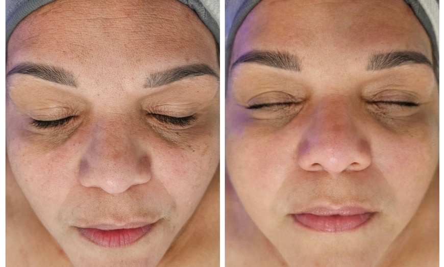 Image 5: Up to 31% Off on HydraFacial at Phoenix Esthetics of CT