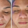 Image 5: Up to 31% Off on HydraFacial at Phoenix Esthetics of CT