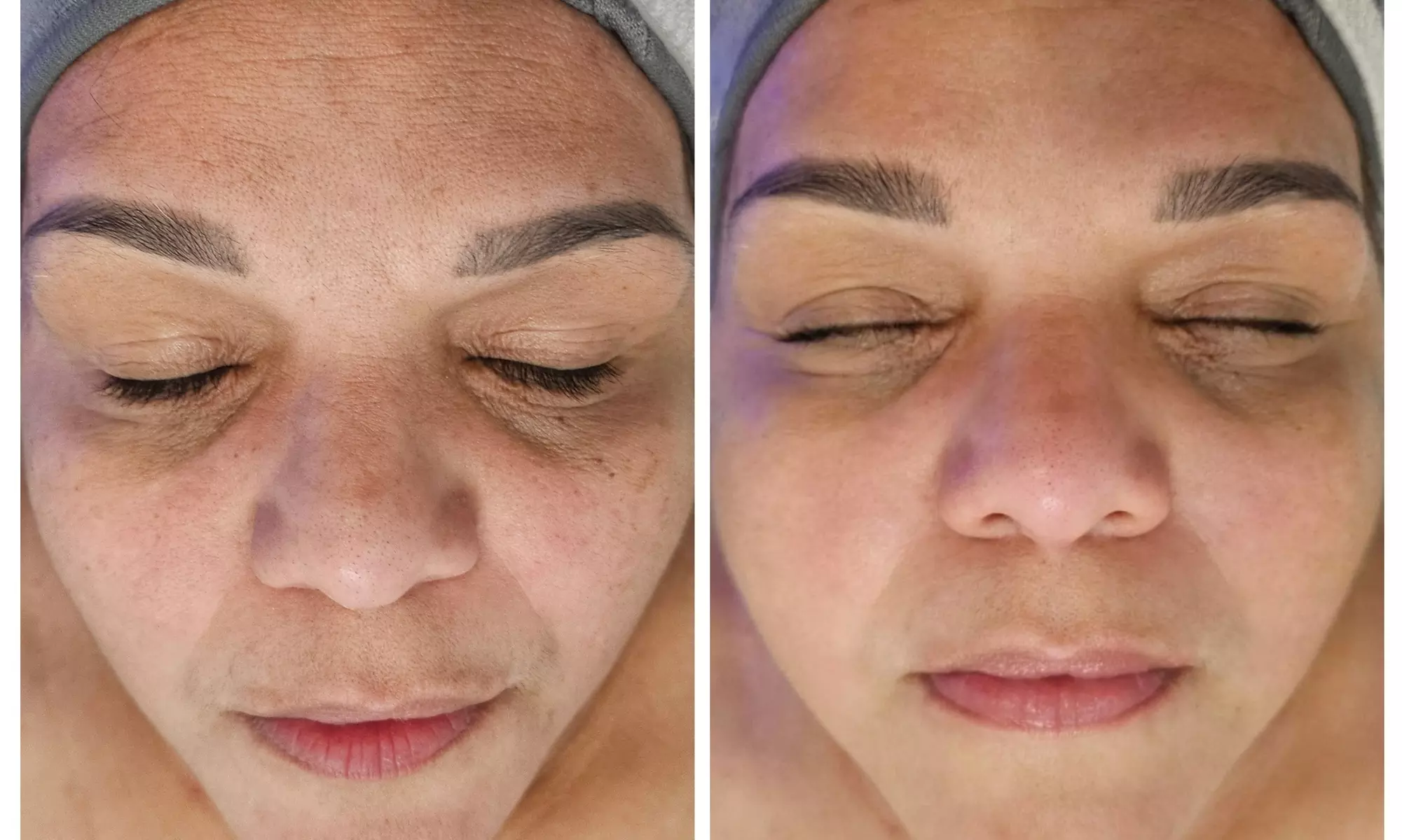 Up to 40% Off on HydraFacial at Phoenix Esthetics of CT