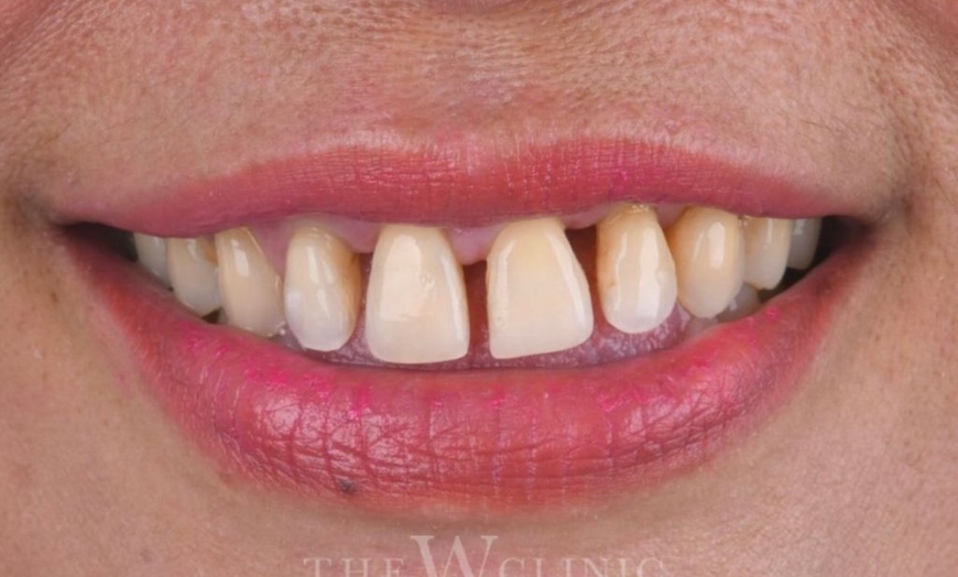 Image 2: Transform Your Smile with a Dental Crown Today