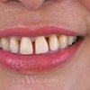 Image 2: Transform Your Smile with a Dental Crown Today