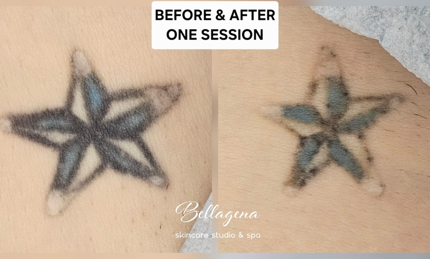 Image 3: Bellagena Offers Three Laser Tattoo Removal Sessions for Small, X-Small, or XX-Small Areas (Up to 56% Off)