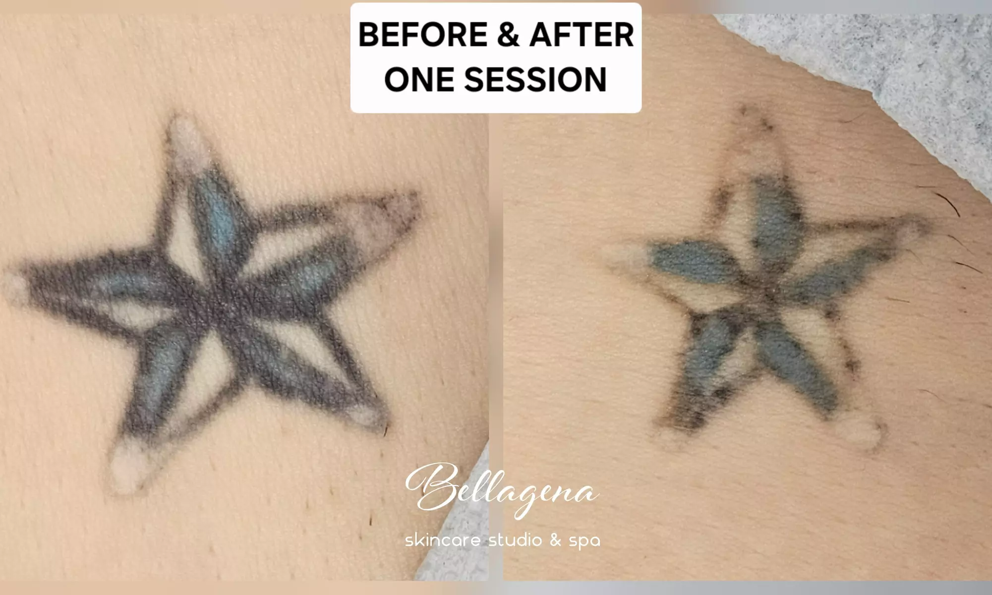 Bellagena Offers Three Laser Tattoo Removal Sessions for Small, X-Small, or XX-Small Areas (Up to 56% Off)