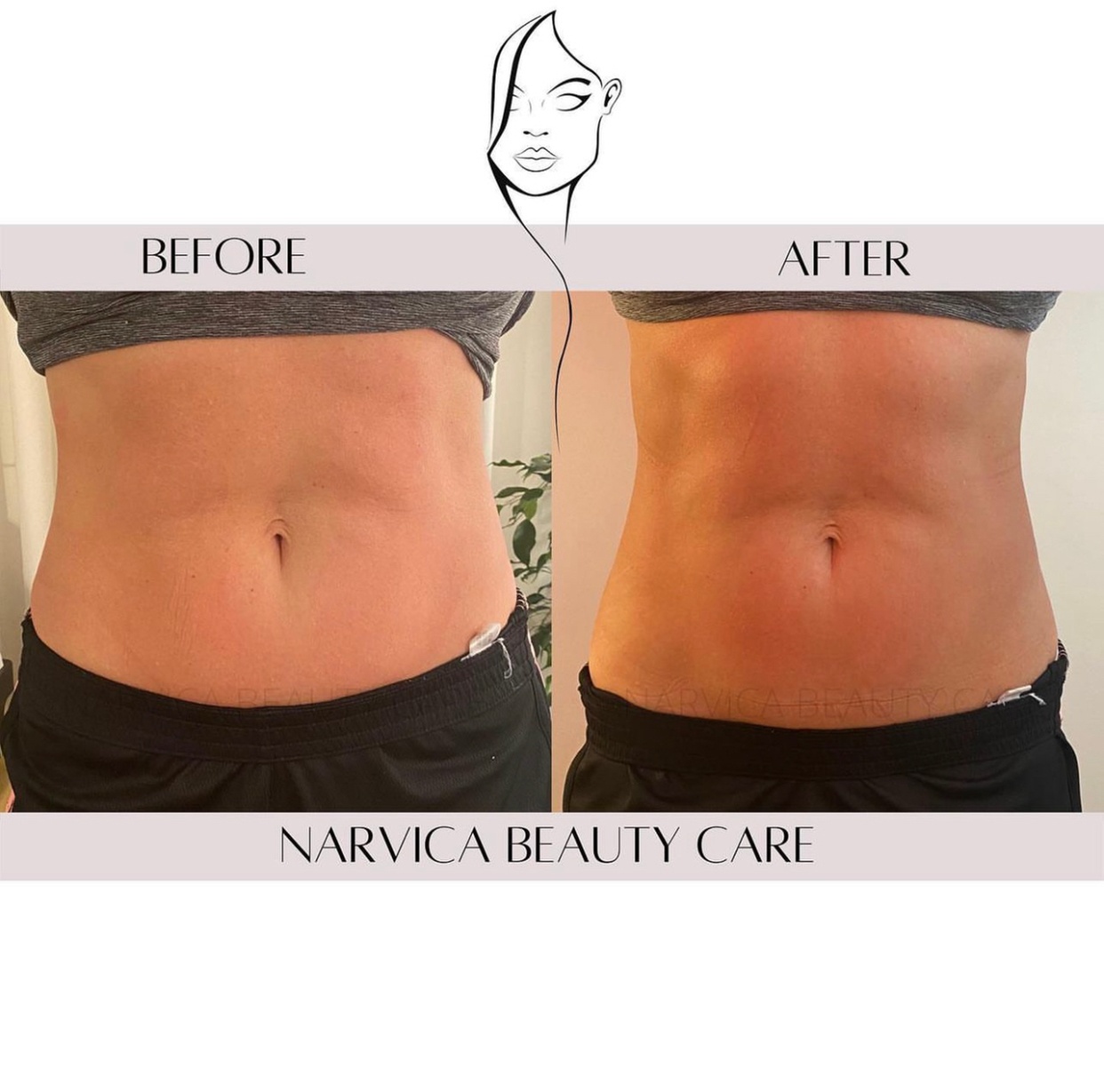Experience Three Emsculpt with Red Light Therapy Sessions for Effective Fat Reduction and Muscle Toning (Up To 30% Off)