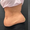 Image 3: Up to 76% Off Electromagnetic Sculpting Treatment