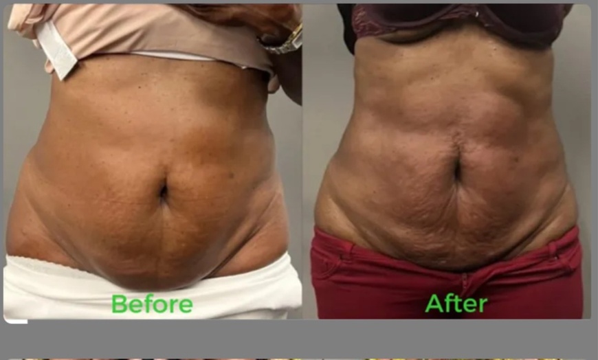 Image 8: One 30 Minutes or 1 Hour Venus Legacy Face or Body Sculpting Session