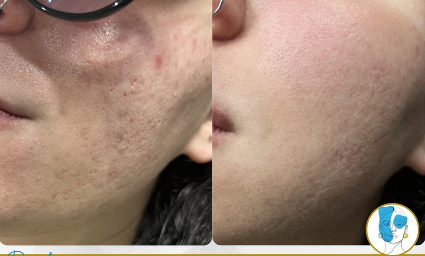 Image 3: Get Two, Four or Six Radio-Frequency Microneedling Treatment 