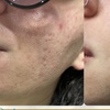Image 3: Get Two, Four or Six Radio-Frequency Microneedling Treatment 
