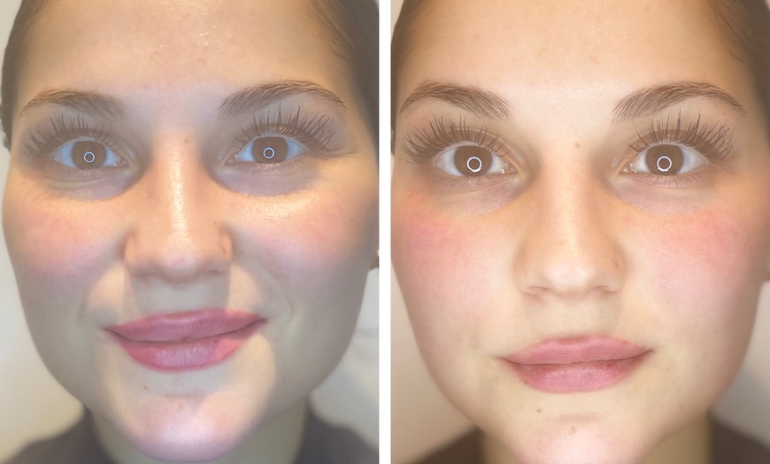 Image 2: Up to 50% Off on Facelift - Non-Surgical at Rescu Wellness