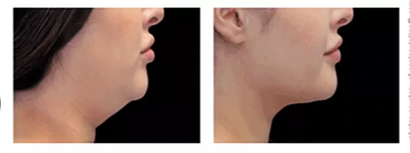 Up to 40% Off on Lipo - Non-Invasive Laser-iLipo at POSH AESTHETICS - Second Medium