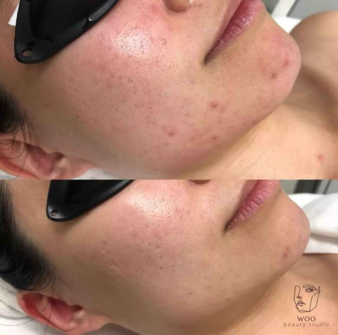 Up to 64% Off on Acne Treatment at Woo Beauty Studio - Primary Image