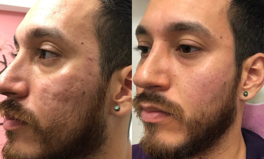 Image 5: Revitalize with 1 or 3 Non-Surgical Facelift and Anti-Aging Treatment