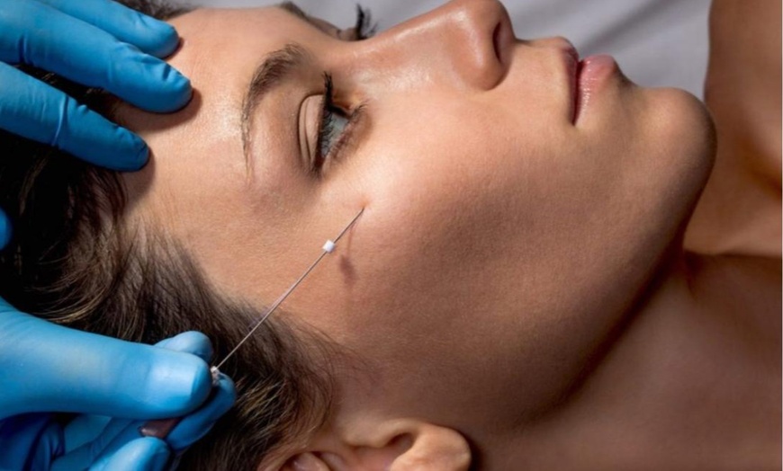 Image 2: Tratamiento de rejuvenecimiento: infiltración de hilos tensores PDO