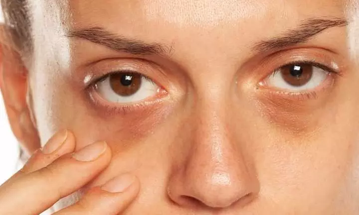 Up to 63% Off on Dark Circle / Under Eye Treatment at UK Aesthetics Lounge