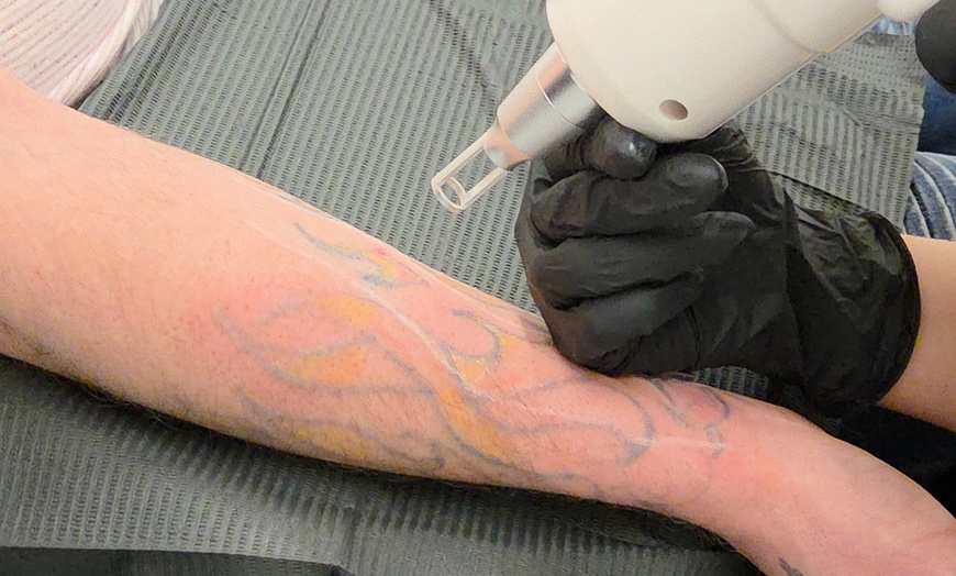 Image 2: Up to 55% Off on Tattoo Removal at Gia laser clinic