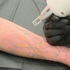 Image 2: Up to 55% Off on Tattoo Removal at Gia laser clinic