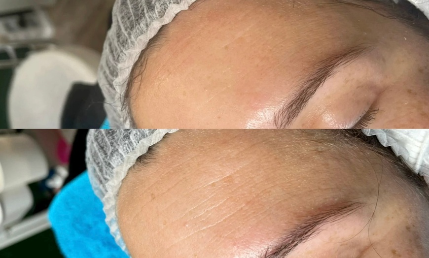 Image 2: Soin du visage lifting coréen au fil de soie sur 1 ou 2 zones