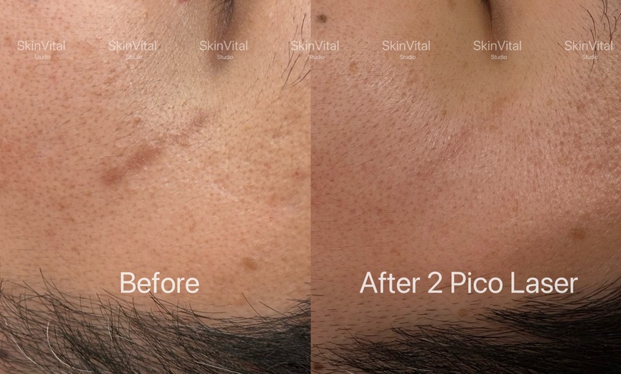 Image 4: Pico Laser Sessions for Small Targeted Areas – 1 or 3 Options 
