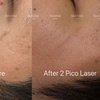 Image 4: Pico Laser Sessions for Small Targeted Areas – 1 or 3 Options 