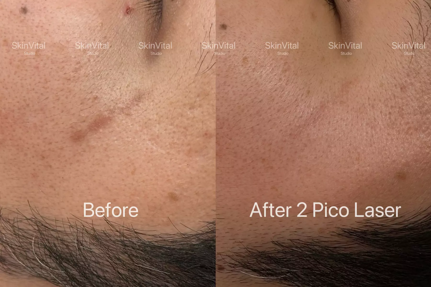 Pico Laser Sessions for Small Targeted Areas – 1 or 3 Options