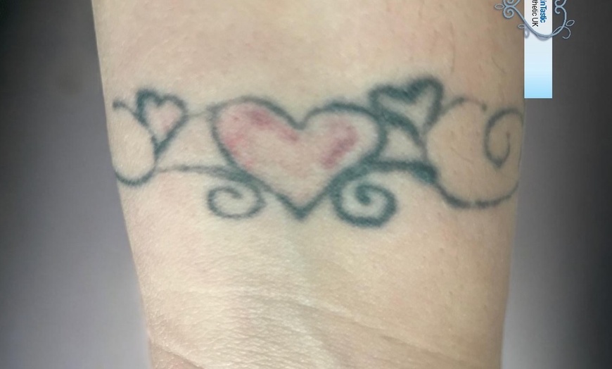 Image 3: Up to 60% Off on Tattoo Removal at Skintastic Aesthetics Treatments