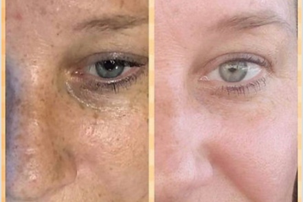 One Advanced Chemical Peel - Rise Skin Spa