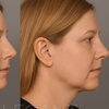 Image 1: Melt Stubborn fat with One or Two Vials of Kybella @ Clinical Care 365