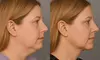 Enhance Your Look with One or Two Vials of Kybella at Clinical Care 365 (Up to 58% Off)