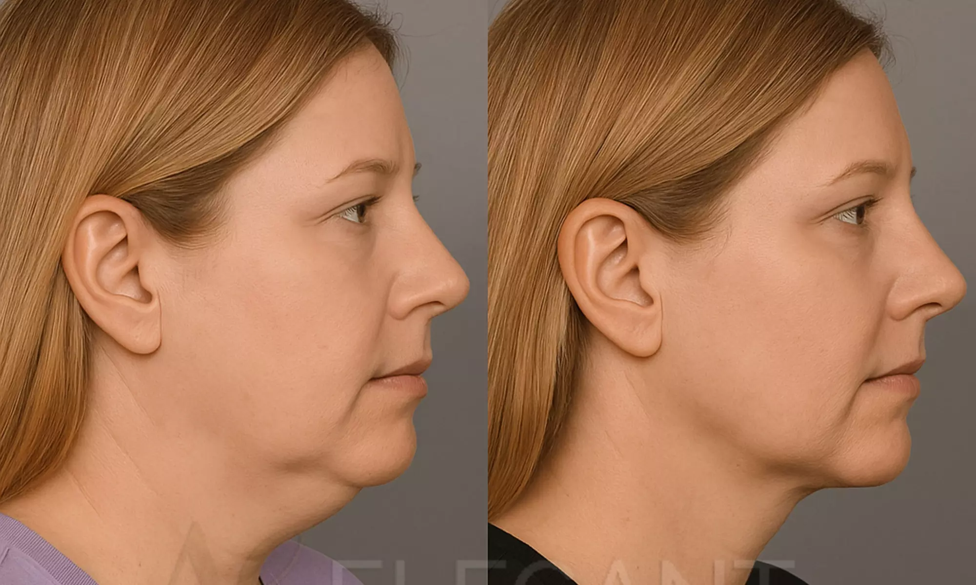 Enhance Your Look with One or Two Vials of Kybella