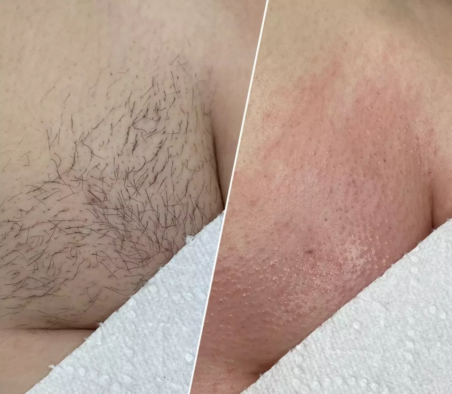 Get Brazilian/Bikini Wax, Vajacial or  Men's Brazilian/ Bikini Wax