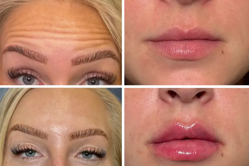 Enhance with 20, 40 or 60 Units of Daxxify Plus 1 Syringe RHA (1ml)