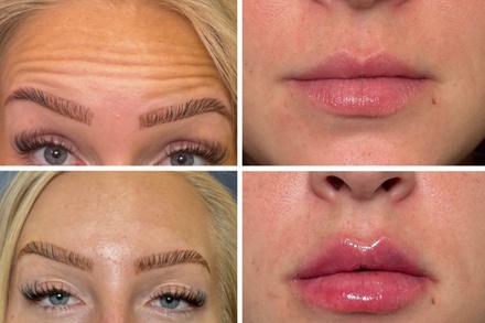 20 Units of Daxxify - Rejuvia Wellness and Medical Spa