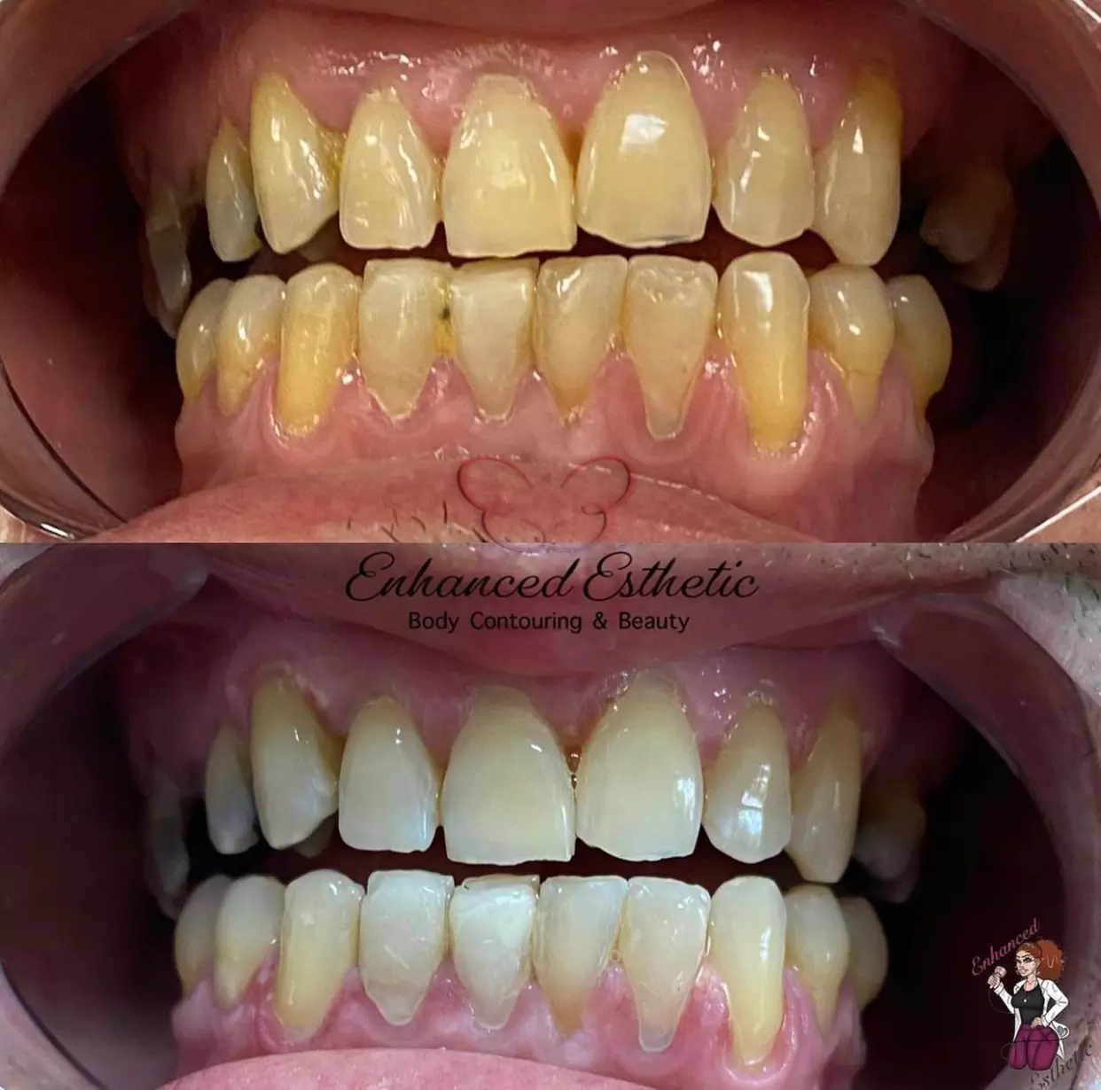 Up to 52% Off on Teeth Whitening at Enhanced Esthetic - Primary Image