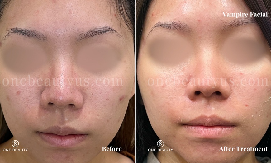 Image 1: Up to 82% Off on Microneedling at One Beauty Aesthetics