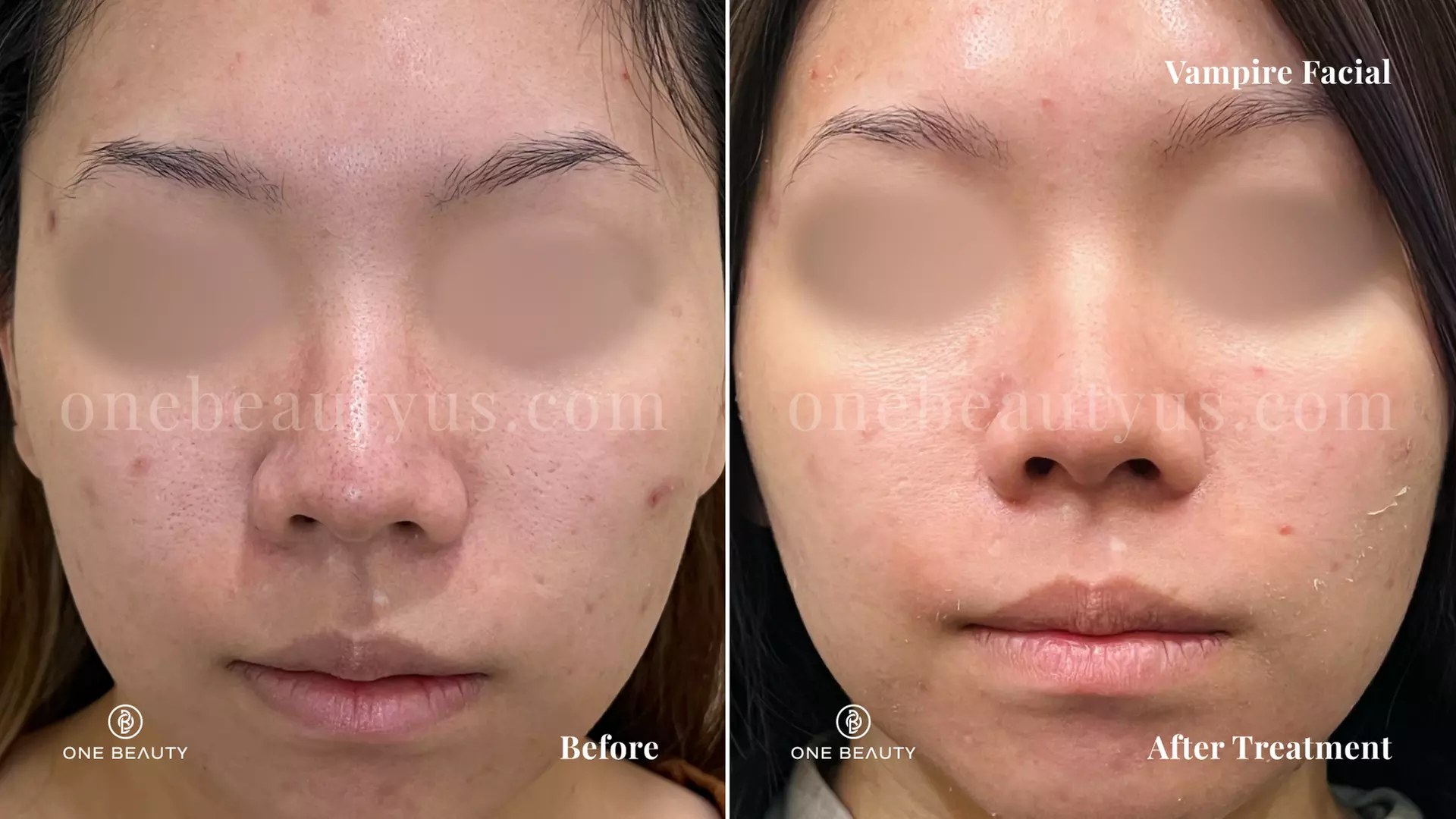 Up to 80% Off on Microneedling at One Beauty Aesthetics - Primary Image